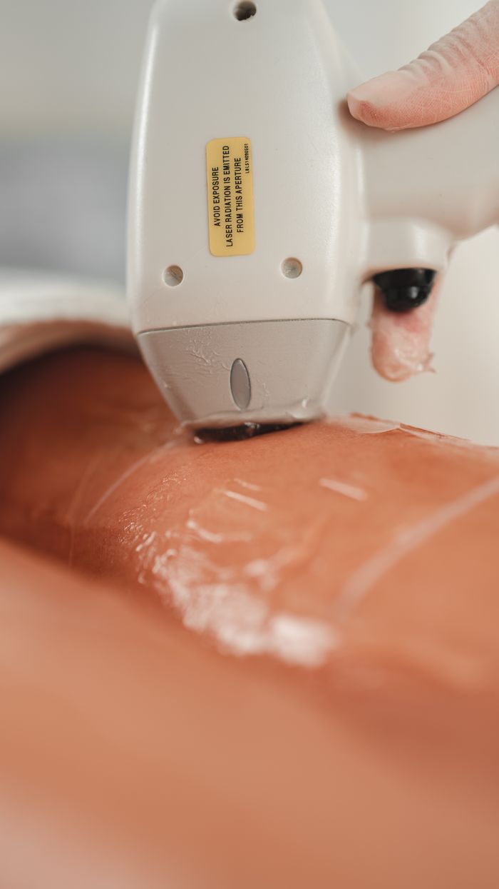 The Art of Drawing Readers In: Your attractive post title goes here Close-up shot of a laser hair removal procedure being performed on skin with cooling gel application.